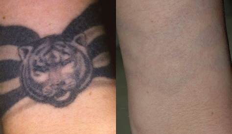 Laser Tattoo Removal Before After Images Alka Skin Clinic Price In Nepal