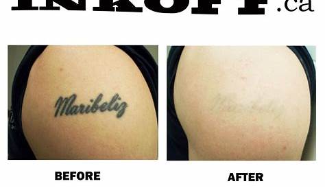 Laser Tattoo Removal Black Ink Before And After Best Skin Care Treatment