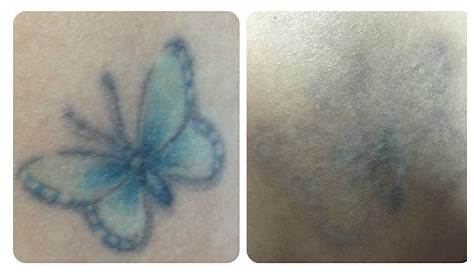 Alka Skin Laser Clinic | Laser Tattoo Removal Price in Nepal, Before