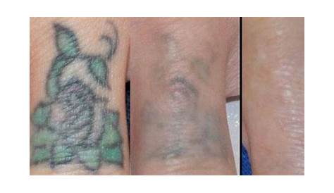 Laser Tattoo Removal Cost Delhi Top 163 + Average Prices By Size