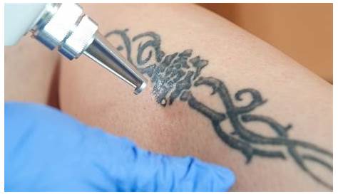 Laser Tattoo Removal Course Melbourne Ct Cost Pretty Amazing Chatroom Navigateur