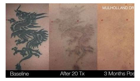 Laser Tattoo Removal Course Toronto Top 165+ South Florida