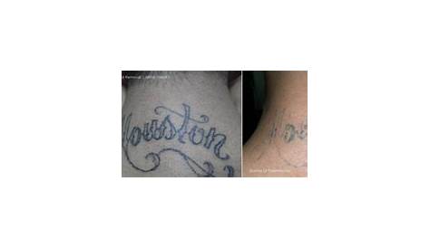 Laser Tattoo Removal In Houston Texas Awasome Ideas Photography