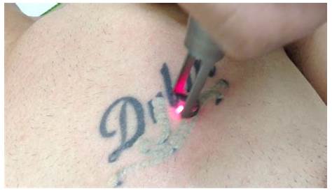 Laser Tattoo Removal In Los Angeles