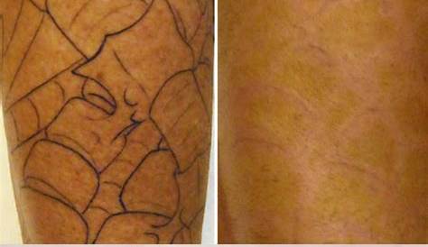 Laser Tattoo Removal Jacksonville Fl Beach Skin Solutions
