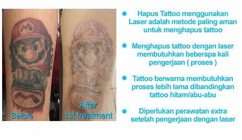 Laser Tattoo Removal Jakarta Cost And How To Do