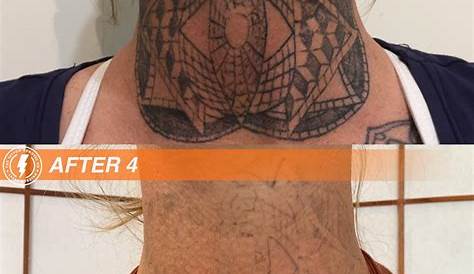 Laser Tattoo Removal Jobs Melbourne Does Really Work On All s? Vanish