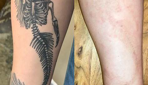Laser Tattoo Removal Journey Facts And Questions Everybody Gets Wrong Bad Habits