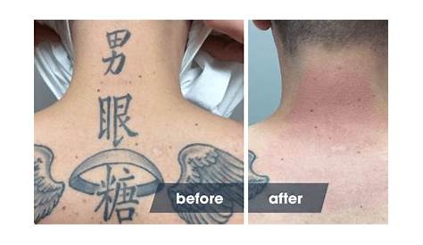 Laser Tattoo Removal Not Healing Cheltenham Forever Clinic Cheltenham