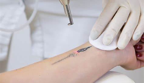 Laser Tattoo Removal Singapore Price Of Everything You Must To Learn About