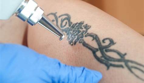 Laser Tattoo Removal Specialist Salary Does Really Work On All s? Vanish