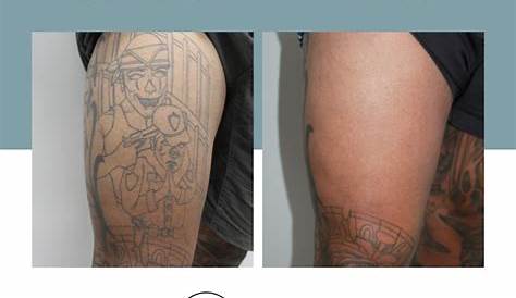Laser Tattoo Removal Sydney Cost Top 56+ Images About After Just Updated
