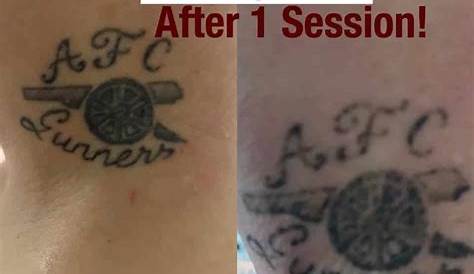 Laser Tattoo Removal Training Mn The Importance Of HandsOn New Look