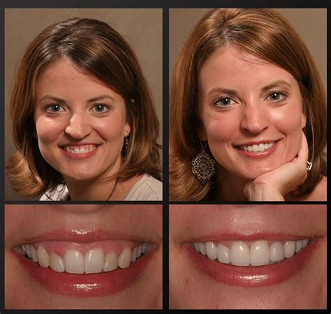 All about Laser Gum Treatment / Dental Wellness Group