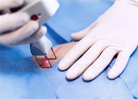 Vascular Laser Advanced Keloid Scar Treatment Premier Clinic