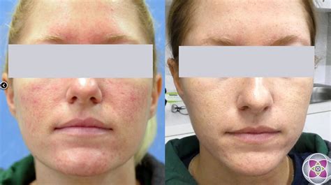 Before & After Photos Vascular Lasers for Redness & Veins Cosmetic