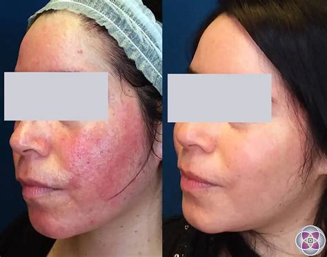 Laser Treatment for Rosacea Richmond Hill Cosmetic Clinic