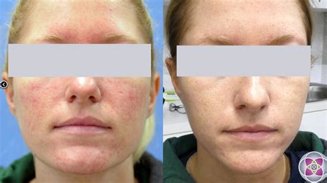 Before and After IPL treatments for rosacea. Rosacea treatment, Laser