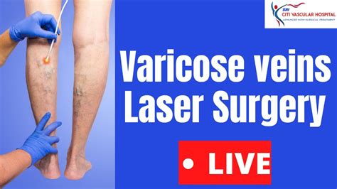 Best Varicose Veins Treatment in Bhiwandi Laser Surgery Cost i by