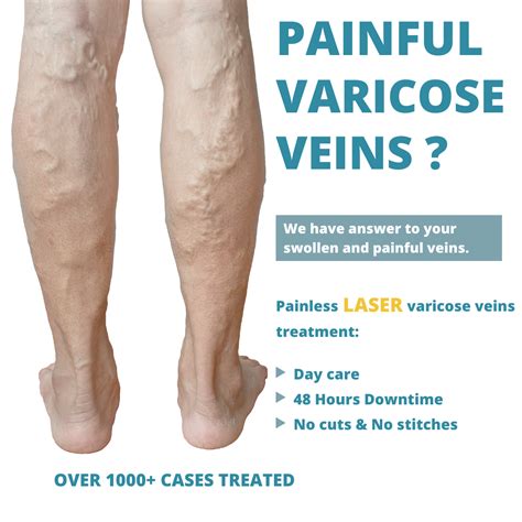 varicose veins laser treatment before after pictures at Maven Medical