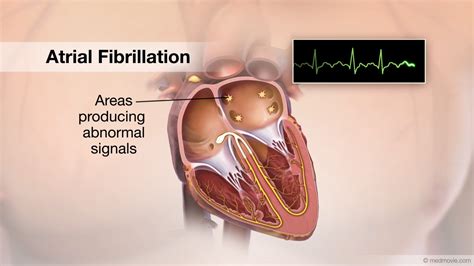 Laser Ablation Atrial Fibrillation