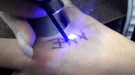 Laser Tattoo Removal in the Bay Area Essential Aesthetics