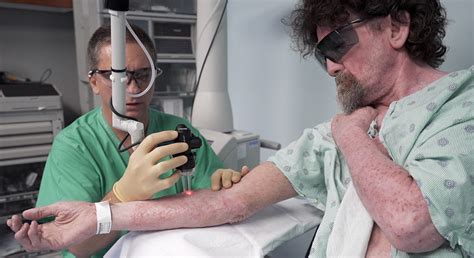 Laser Burn Definition