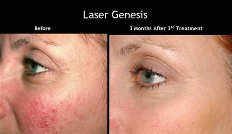 Laser Genesis Therapy