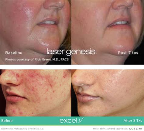 Laser Genesis While Pregnant