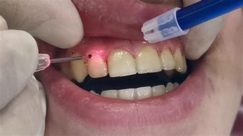 Laser Gingivectomy Post Op Instructions