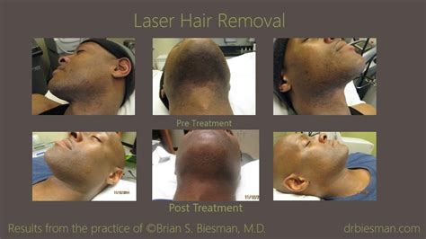 laser hair removal black owned