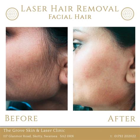 laser hair removal cost near me for face