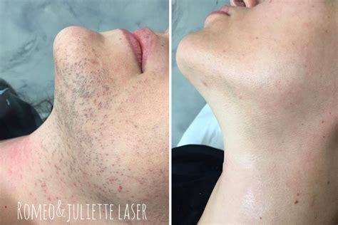 laser hair removal for pcos facial hair