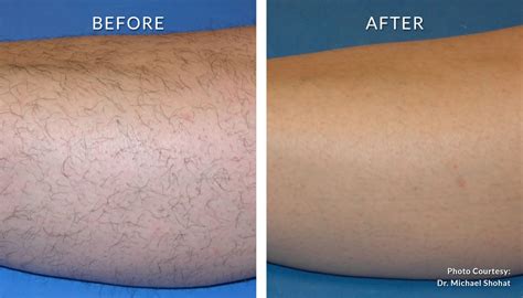 laser hair removal full brazilian