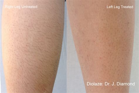 laser hair removal johnson city tn