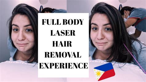 laser hair removal manila