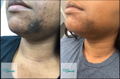 laser hair removal near me black skin