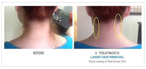 laser hair removal neck hairline