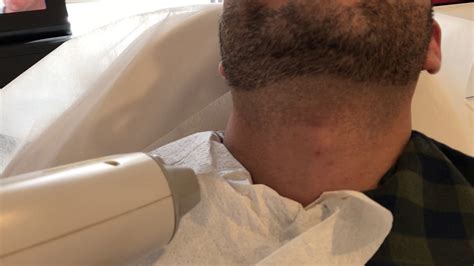 laser hair removal neck ingrown hairs