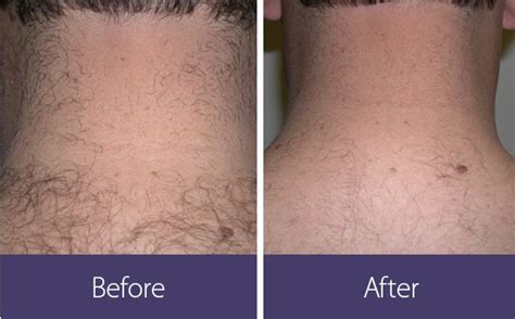 laser hair removal neck men shave