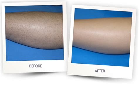 laser hair removal north scottsdale