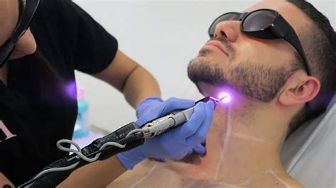 laser hair removal nyc for men groupon