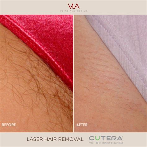 laser hair removal on bikini area