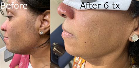 laser hair removal on chin cost