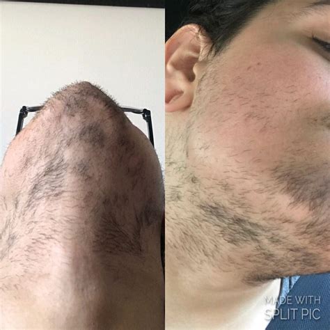 laser hair removal reddit