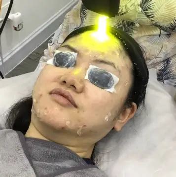 Lazer Jerawat Batu: Cara Ampuh Atasi Jerawat Batu tanpa Bekas