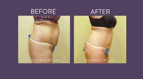 Laser Lipo Okc