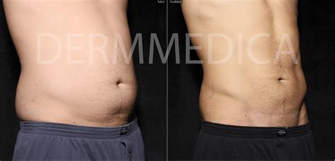 Laser Liposuction Kelowna Bc