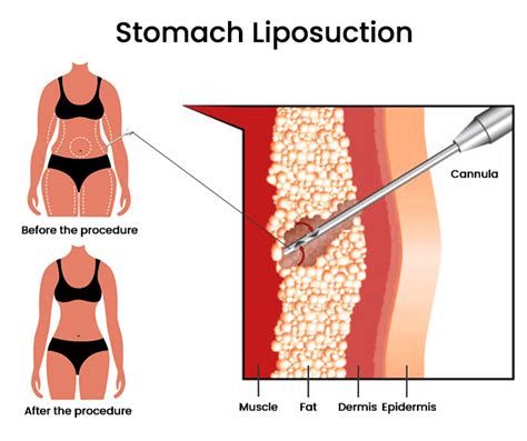 Laser Liposuction Washington State