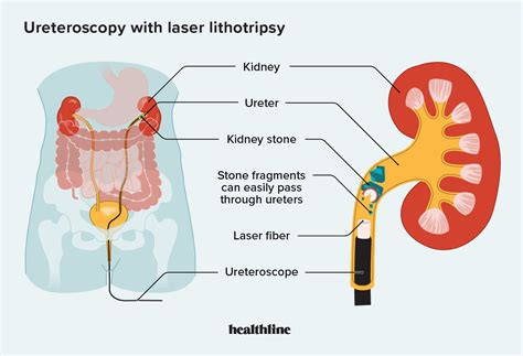 laser lithotripsy cpt code